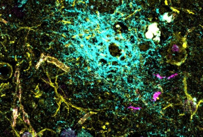 An amyloid plaque from a whale