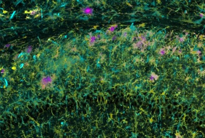 Microglia and astrocyte cells around amyloid beta