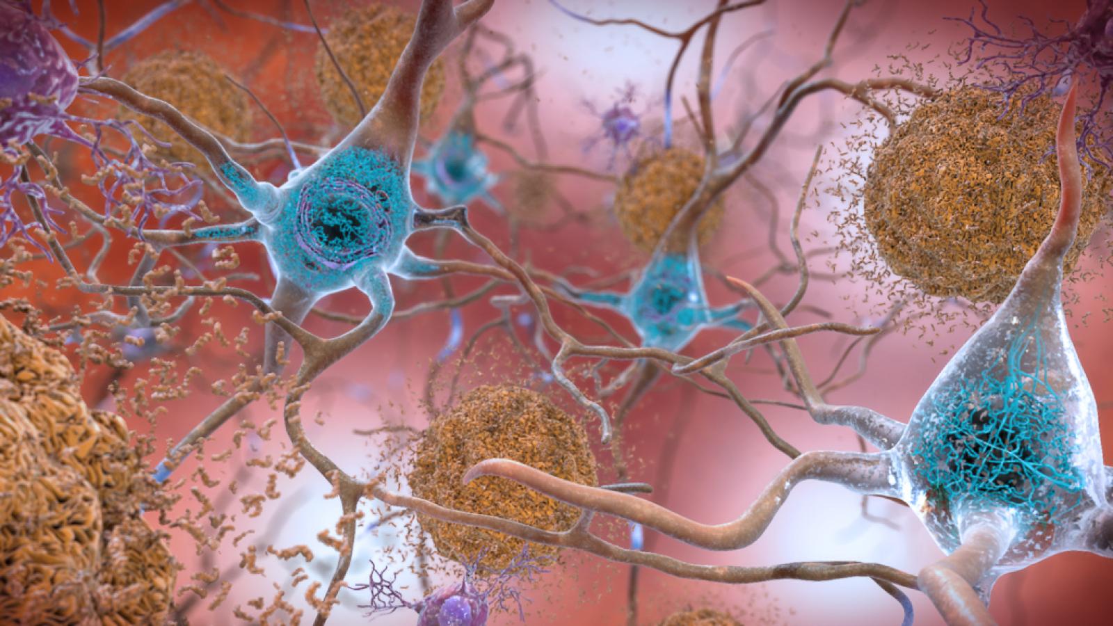 Illustration of Alzheimer's pathology