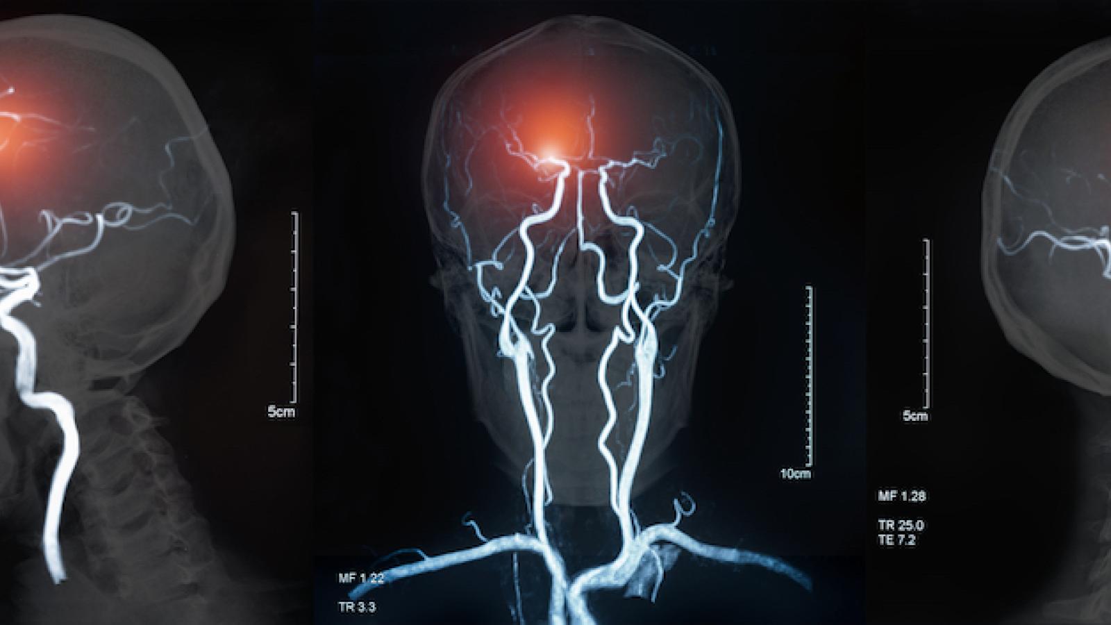 MRI stroke - shutterstock create jobs 51