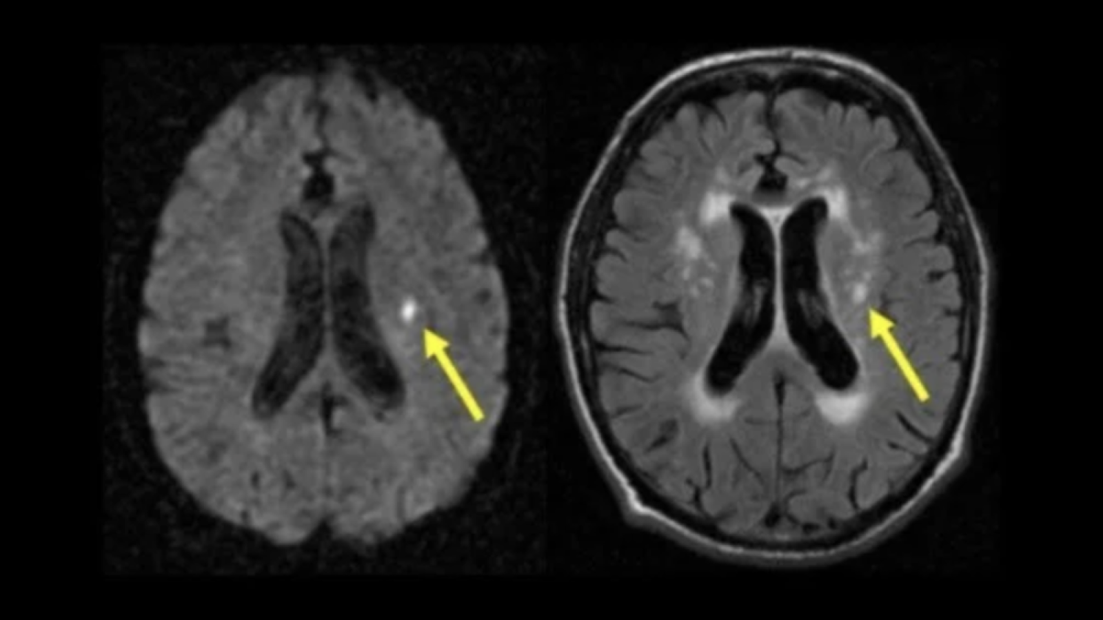 MRI scan showing lacunar stroke