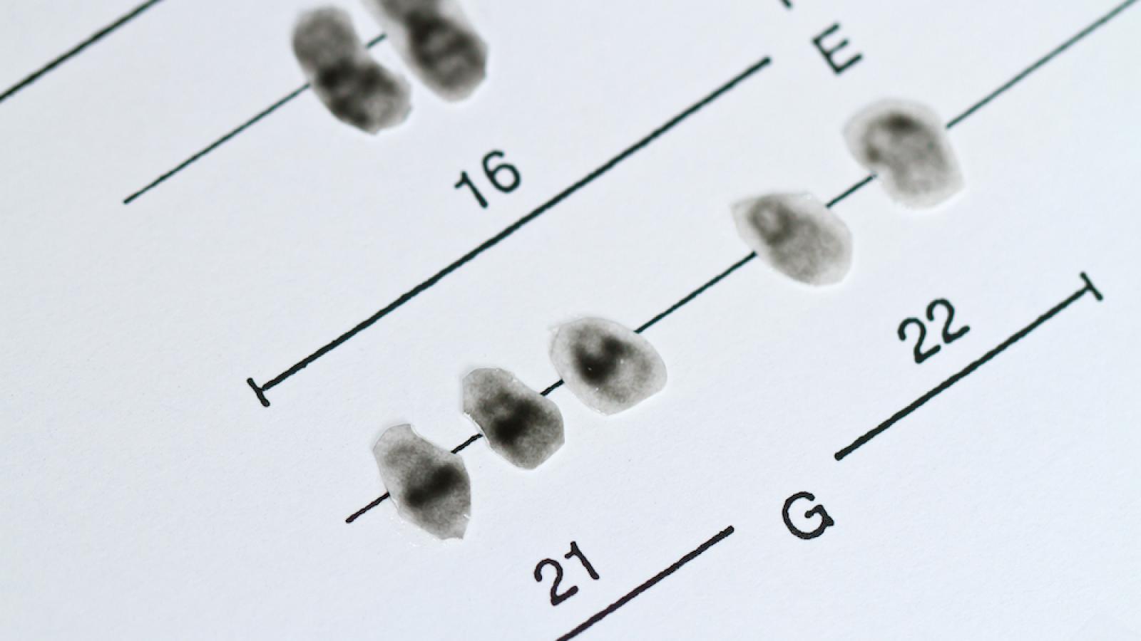 Down syndrome trisomy