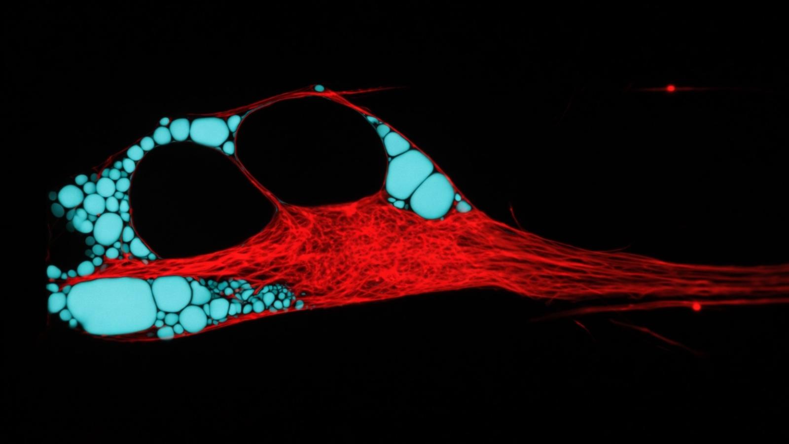 Human neuron with pathologically perturbed ER