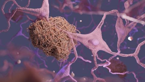 Amyloid plaques in the brain