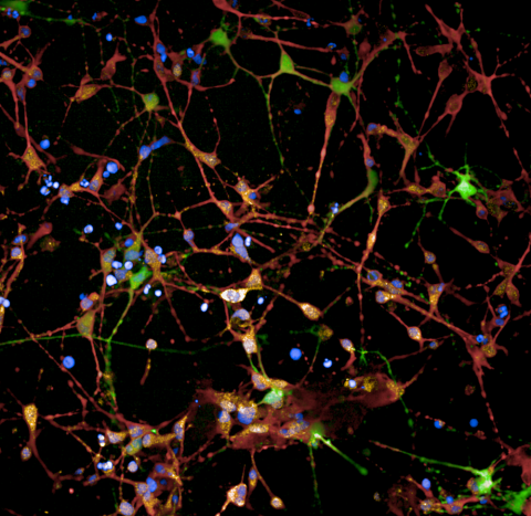 Huntington's patient brain cells