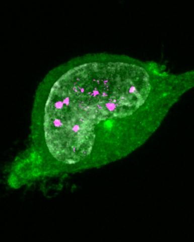 TREX1 with an RVCL mutation (Green) is mislocalised throughout the cell, including in the nucleus where it causes DNA damage (53BP1, magenta).