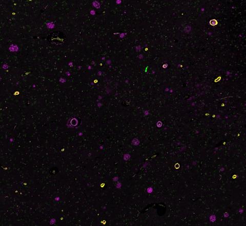 a section of brain tissue from a person with both cerebral amyloid angiopathy (CAA) and Alzheimer’s disease.