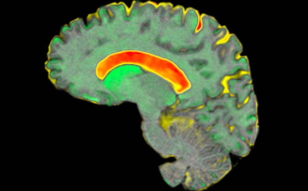 A scan of a huntington's brain