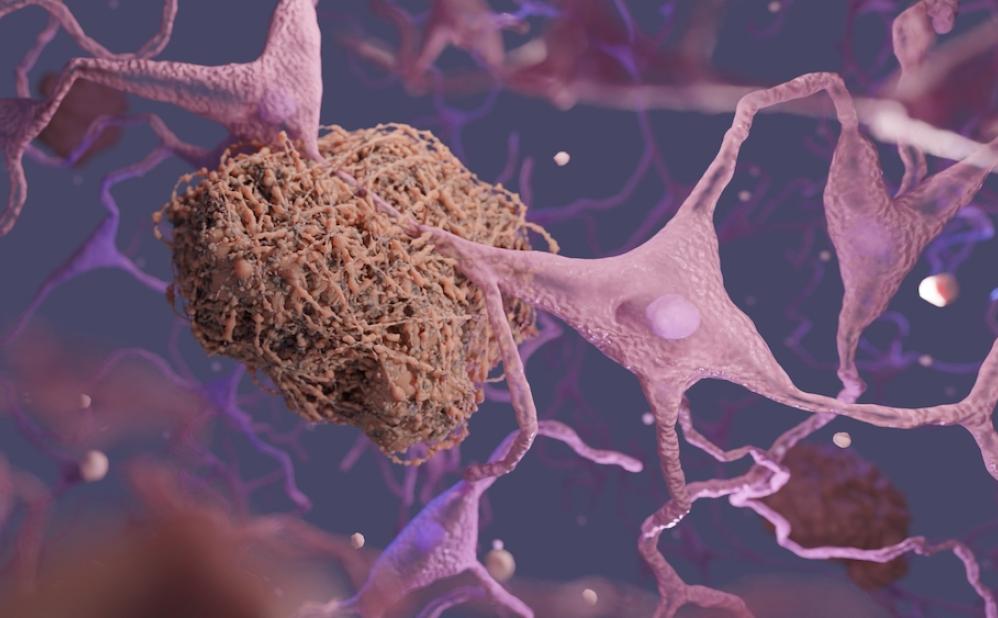 Amyloid plaques in the brain