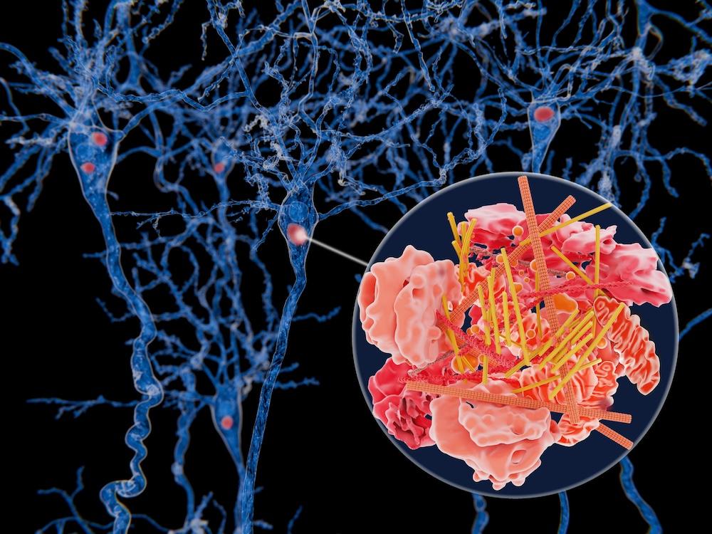 Neurons with Lewy bodies rendering