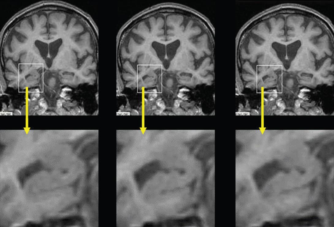 MRI scans showing the reduction of the hippocampus in Alzheimer's