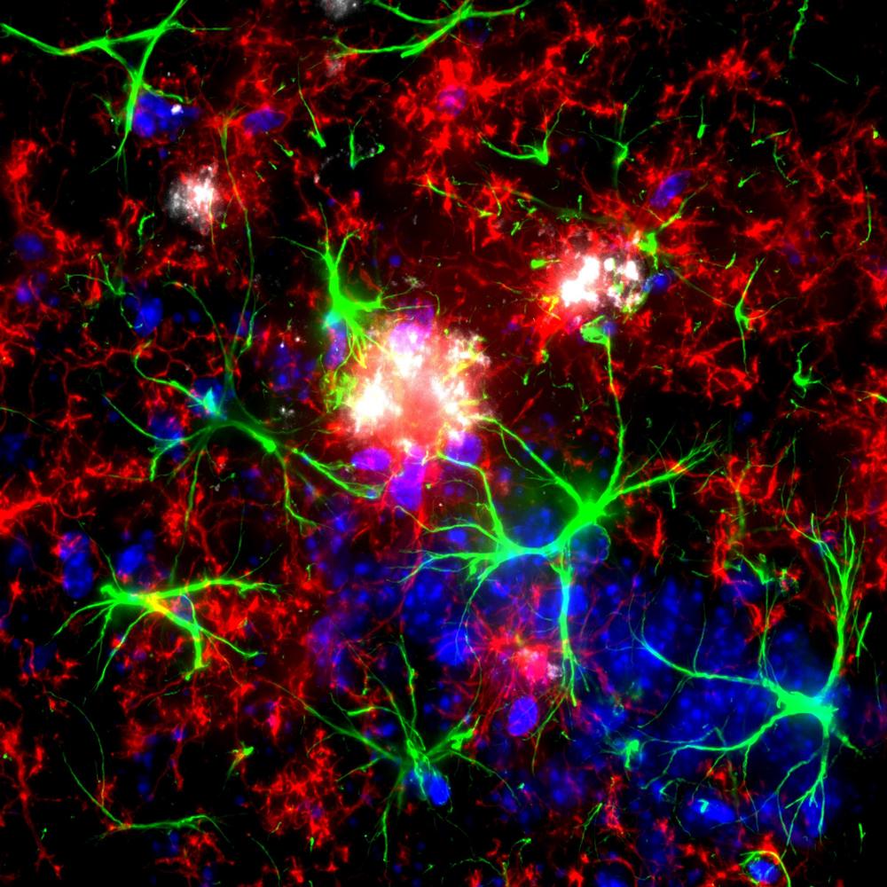 Microglia and astrocytes around amyloid plaque